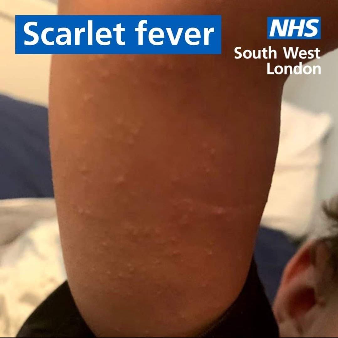 Strep A And Scarlet Fever Sheen Surgery 